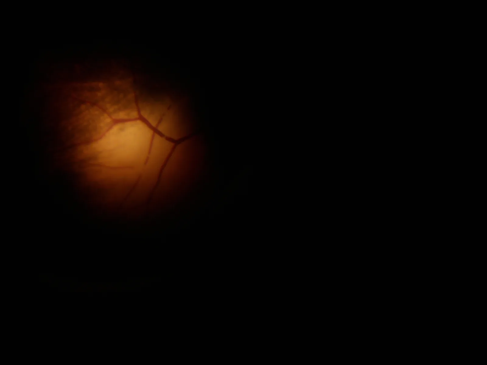 A retinal blood vessel seen through a microscope, transilluminated by the Mark XI