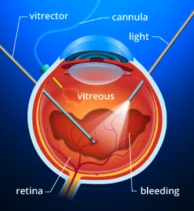 Diagram of Eye Surgery