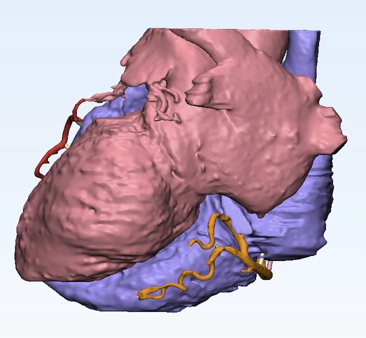 The heart model in 3Matics with support structures and magnet attachment points added