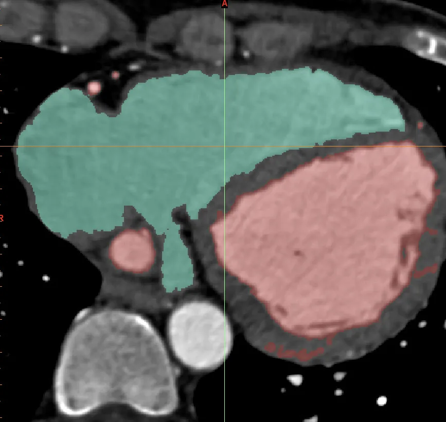 The segmented cardiac blood volume in Mimics, the left side in red and the right in blue